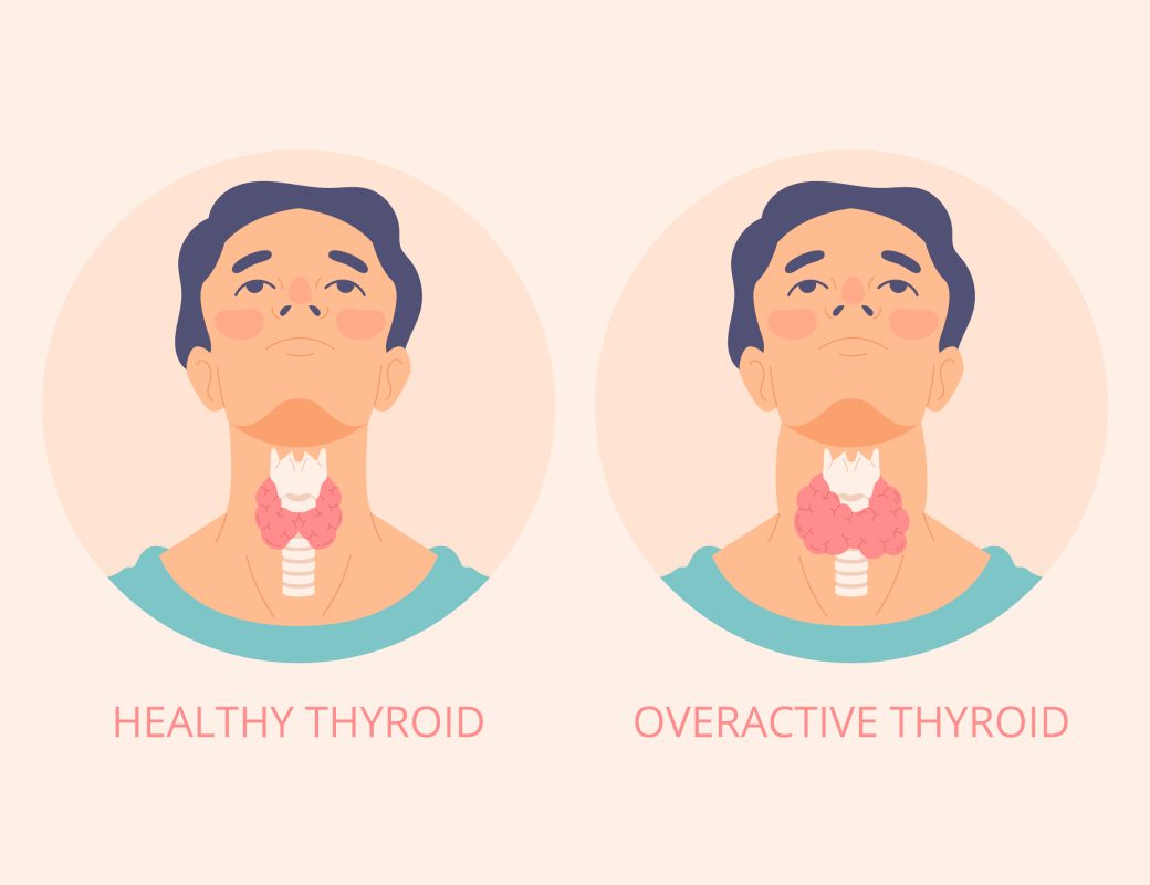 Managing Hypothyroidism: Lifelong Treatment & Healthy Living